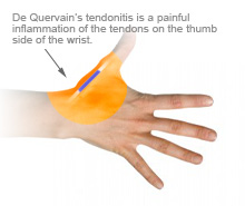 De Quervain S Tendonitis Glenn D Cohen M D